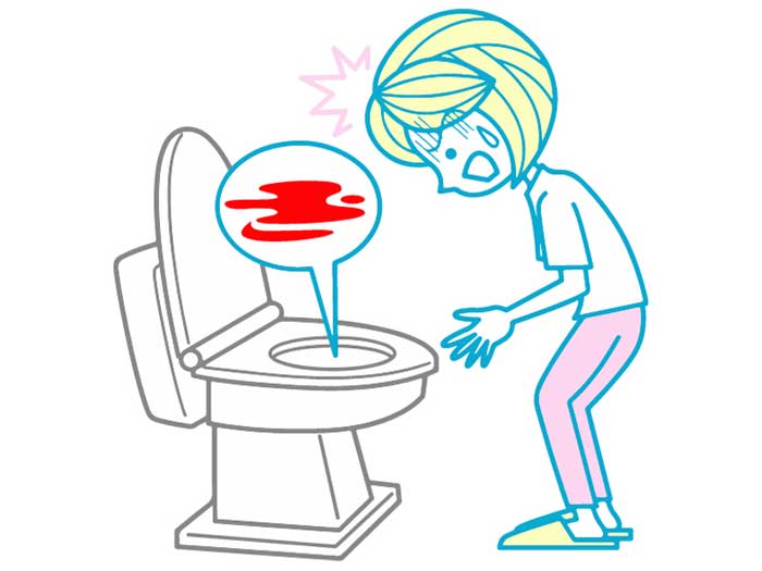 血尿の原因は疲労とストレス・トイレの我慢｜女性は膀胱炎になりやすい