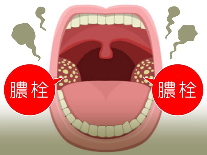 喉の違和感の原因は見えない臭い玉