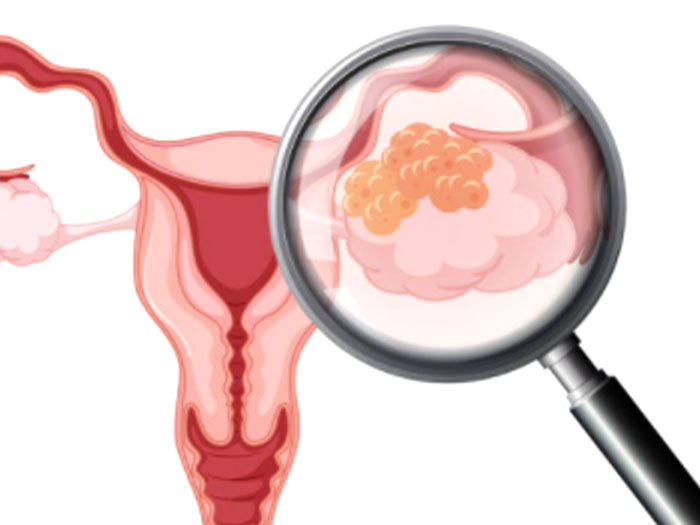 子宮内膜症性卵巣嚢腫